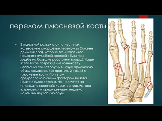 перелом плюсневой кости В отдельный раздел стоит отнести так называемые «маршевые переломы»