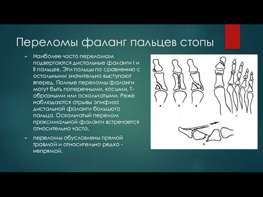 Переломы фаланг пальцев стопы Наиболее часто переломам подвергаются дистальные фаланги I и