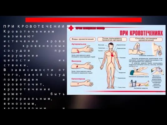 ПРИ КРОВОТЕЧЕНИИ Кровотечением называют истечение крови из кровеносных сосудов при нарушении целости