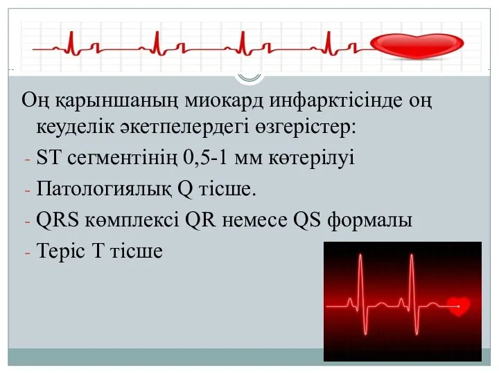 Оң қарыншаның миокард инфарктісінде оң кеуделік әкетпелердегі өзгерістер: ST сегментінің 0,5-1 мм
