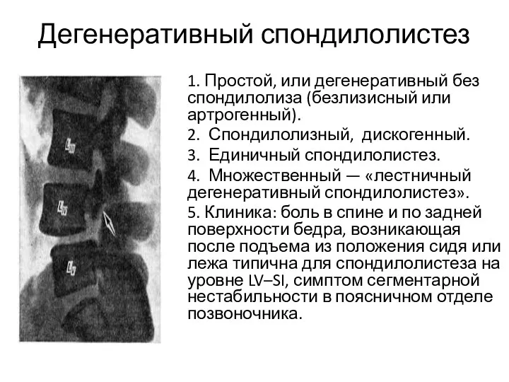 Дегенеративный спондилолистез 1. Простой, или дегенеративный без спондилолиза (безлизисный или артрогенный). 2.