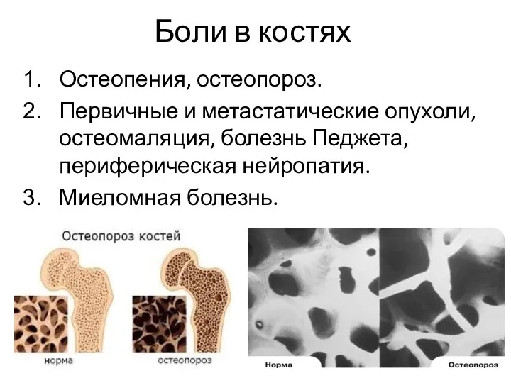 Боли в костях Остеопения, остеопороз. Первичные и метастатические опухоли, остеомаляция, болезнь Педжета, периферическая нейропатия. Миеломная болезнь.