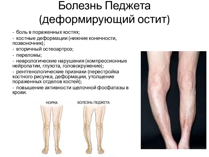 Болезнь Педжета (деформирующий остит) - боль в пораженных костях; - костные деформации