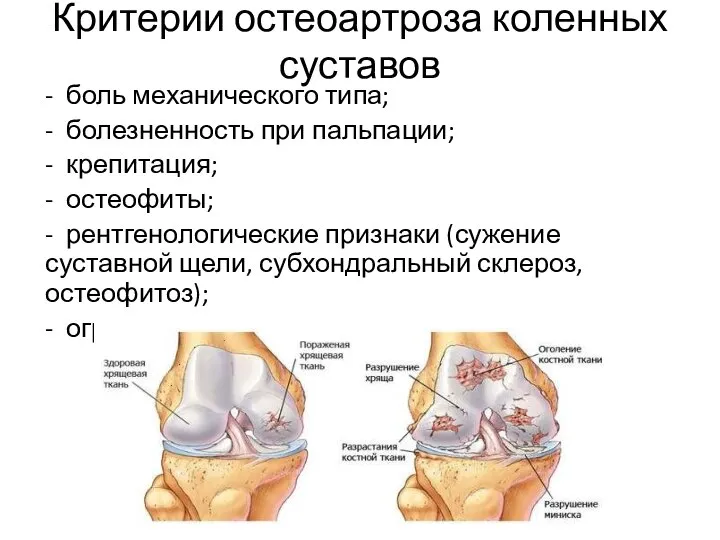 Критерии остеоартроза коленных суставов - боль механического типа; - болезненность при пальпации;