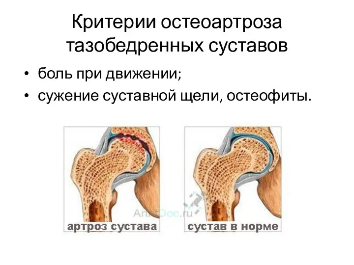 Критерии остеоартроза тазобедренных суставов боль при движении; сужение суставной щели, остеофиты.