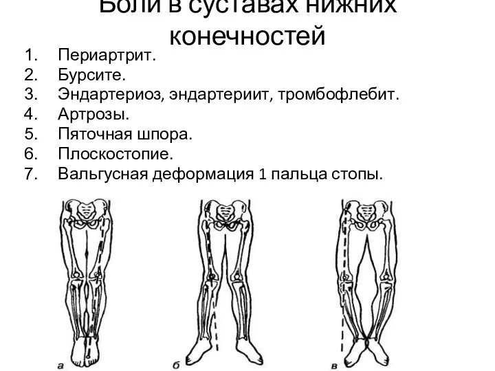 Боли в суставах нижних конечностей Периартрит. Бурсите. Эндартериоз, эндартериит, тромбофлебит. Артрозы. Пяточная