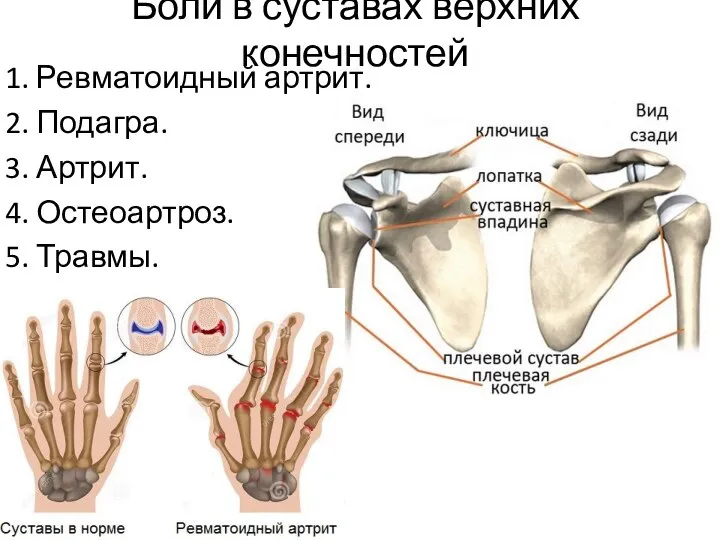 Боли в суставах верхних конечностей 1. Ревматоидный артрит. 2. Подагра. 3. Артрит. 4. Остеоартроз. 5. Травмы.