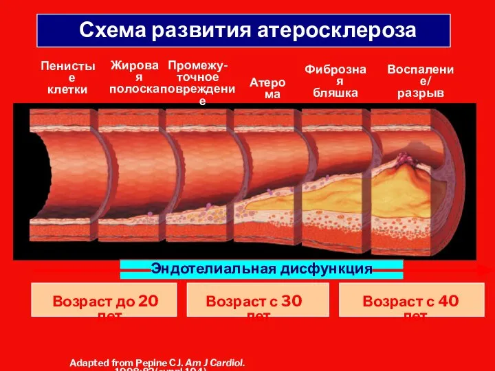 Схема развития атеросклероза Пенистые клетки Жировая полоска Промежу- точное повреждение Атерома Фиброзная