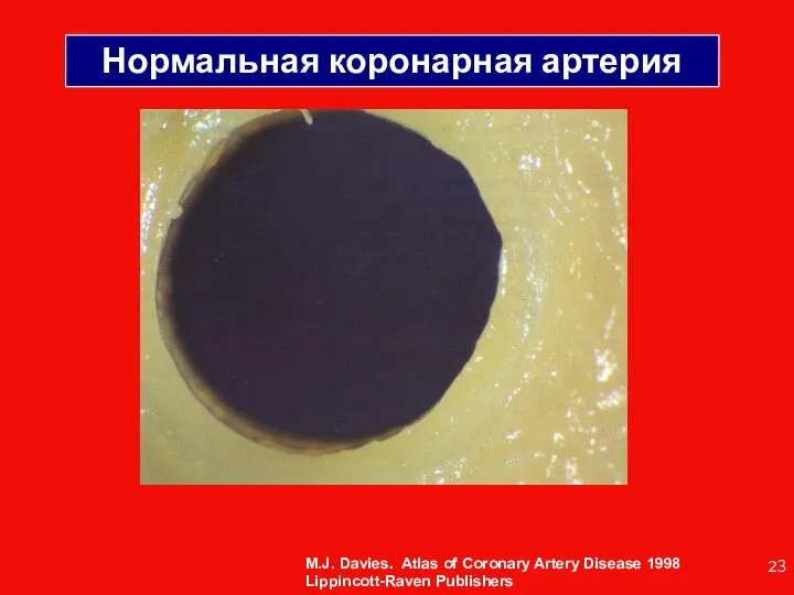 Нормальная коронарная артерия M.J. Davies. Atlas of Coronary Artery Disease 1998 Lippincott-Raven Publishers