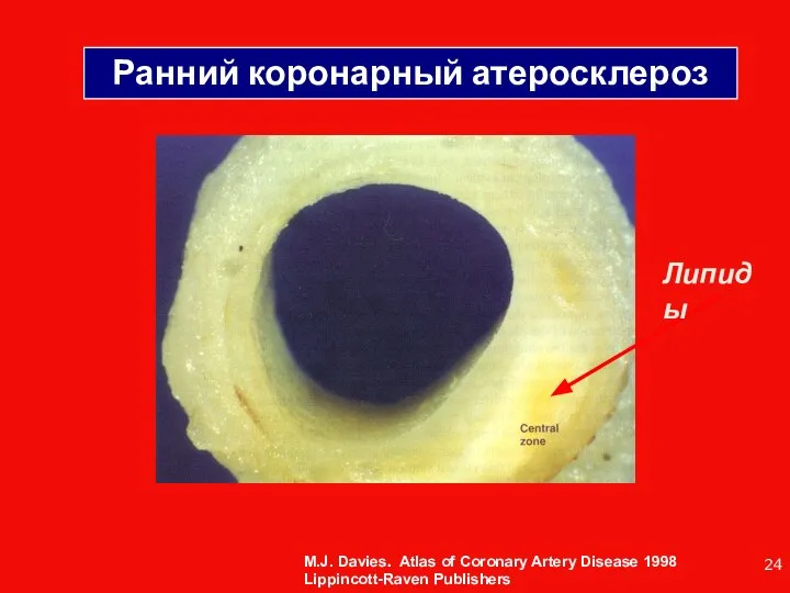 Ранний коронарный атеросклероз M.J. Davies. Atlas of Coronary Artery Disease 1998 Lippincott-Raven Publishers Липиды