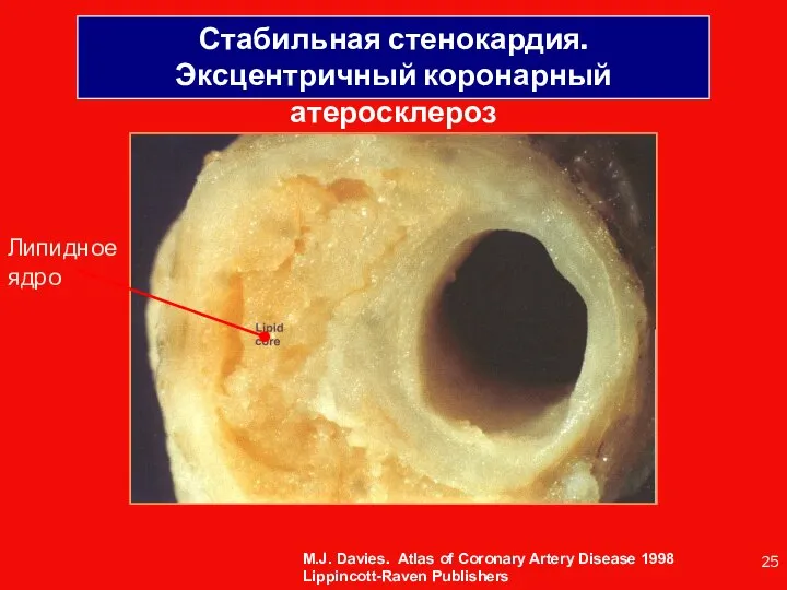 Стабильная стенокардия. Эксцентричный коронарный атеросклероз Липидное ядро M.J. Davies. Atlas of Coronary