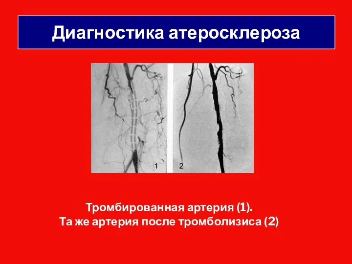 Тромбированная артерия (1). Та же артерия после тромболизиса (2) Диагностика атеросклероза