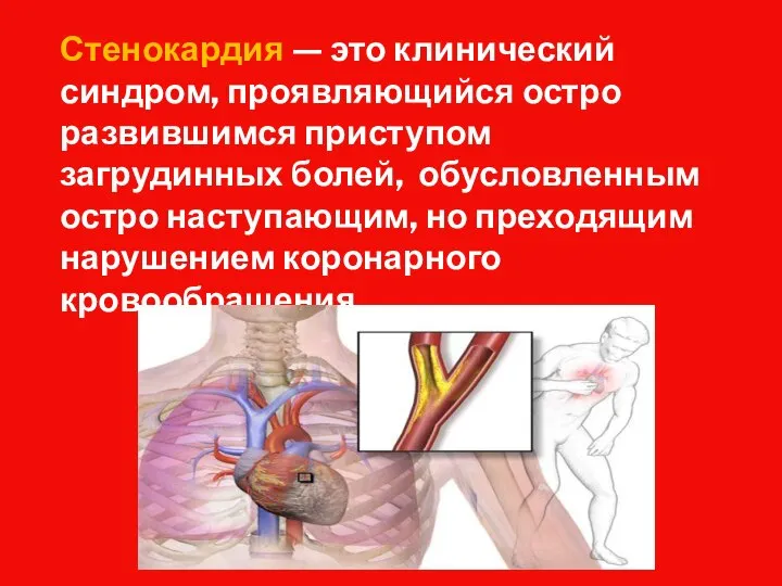 Стенокардия — это клинический синдром, проявляющийся остро развившимся приступом загрудинных болей, обусловленным