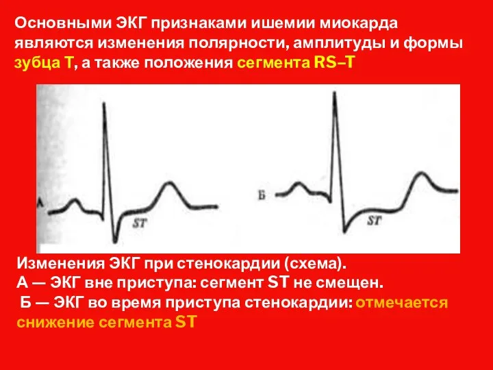 Основными ЭКГ признаками ишемии миокарда являются изменения полярности, амплитуды и формы зубца