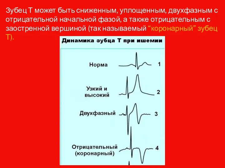 Зубец Т может быть сниженным, уплощенным, двухфазным с отрицательной начальной фазой, а