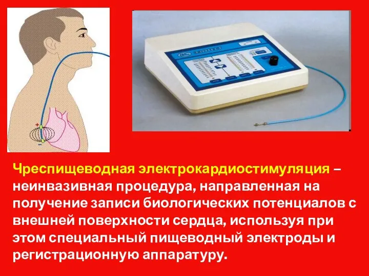 Чреспищеводная электрокардиостимуляция – неинвазивная процедура, направленная на получение записи биологических потенциалов с