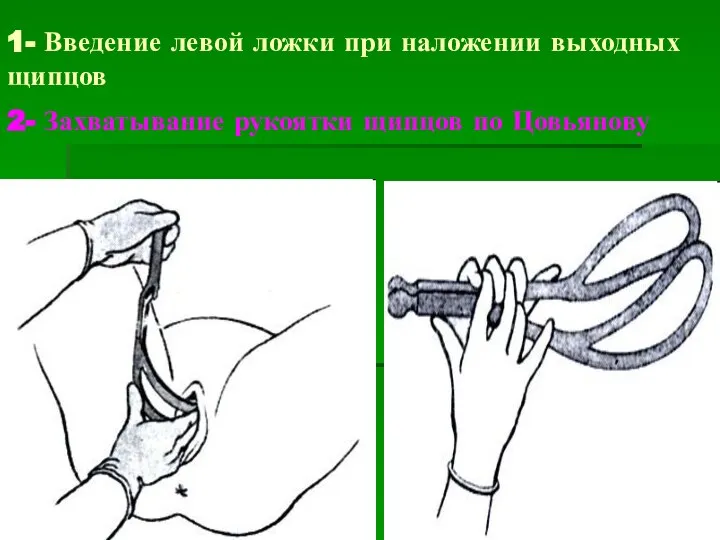 1- Введение левой ложки при наложении выходных щипцов 2- Захватывание рукоятки щипцов по Цовьянову
