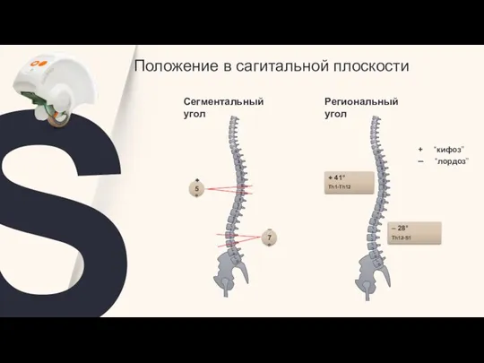 L5 – 28° Th12-S1 + 41° Th1-Th12 L5 +5° –7° Региональный угол