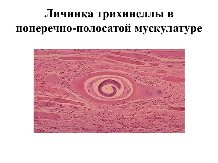 Личинка трихинеллы в поперечно-полосатой мускулатуре