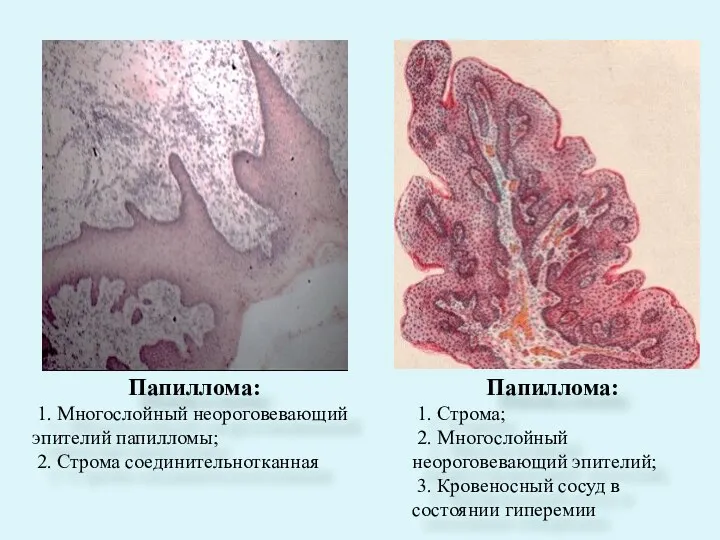 Папиллома: 1. Многослойный неороговевающий эпителий папилломы; 2. Строма соединительнотканная Папиллома: 1. Строма;
