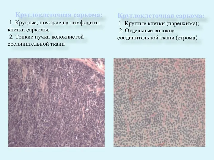 Круглоклеточная саркома: 1. Круглые, похожие на лимфоциты клетки саркомы; 2. Тонкие пучки