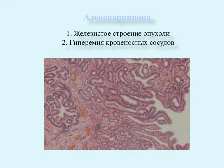 Аденокарцинома 1. Железистое строение опухоли 2. Гиперемия кровеносных сосудов