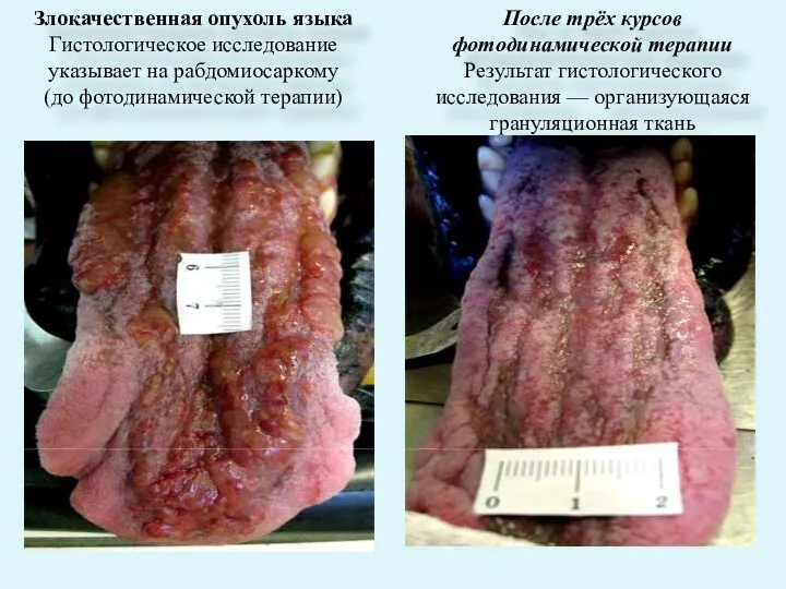 Злокачественная опухоль языка Гистологическое исследование указывает на рабдомиосаркому (до фотодинамической терапии) После