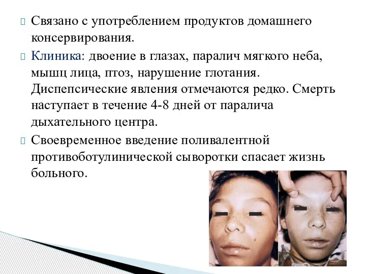 Связано с употреблением продуктов домашнего консервирования. Клиника: двоение в глазах, паралич мягкого