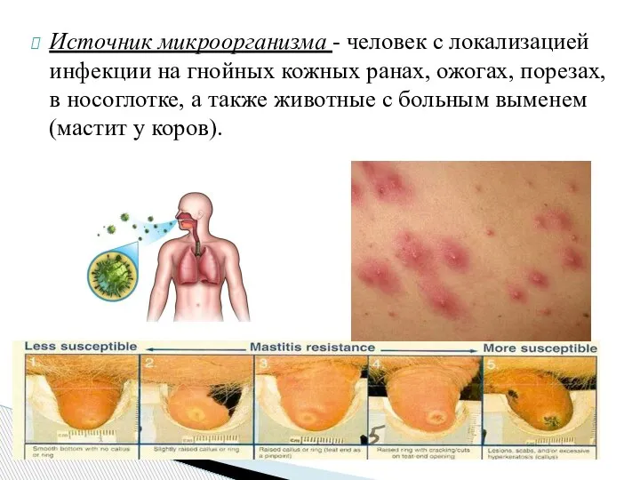 Источник микроорганизма - человек с локализацией инфекции на гнойных кожных ранах, ожогах,