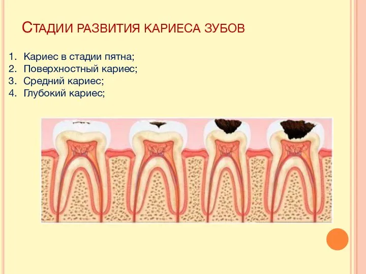 СТАДИИ РАЗВИТИЯ КАРИЕСА ЗУБОВ Кариес в стадии пятна; Поверхностный кариес; Средний кариес; Глубокий кариес;