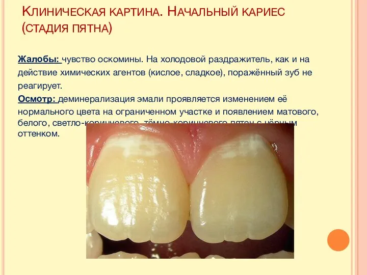 КЛИНИЧЕСКАЯ КАРТИНА. НАЧАЛЬНЫЙ КАРИЕС (СТАДИЯ ПЯТНА) Жалобы: чувство оскомины. На холодовой раздражитель,