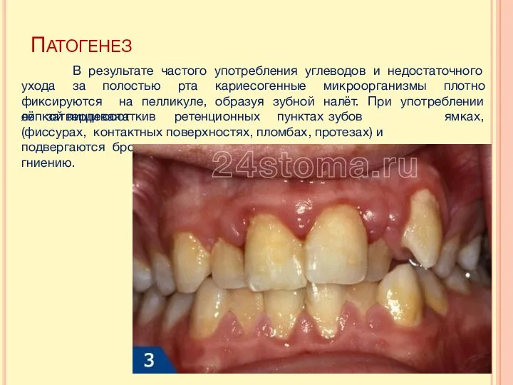 ПАТОГЕНЕЗ В результате частого употребления углеводов и недостаточного ухода за полостью рта