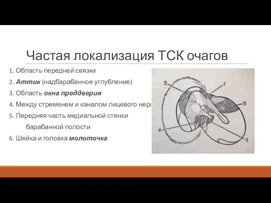 Частая локализация ТСК очагов 1. Область передней связки 2. Аттик (надбарабанное углубление)