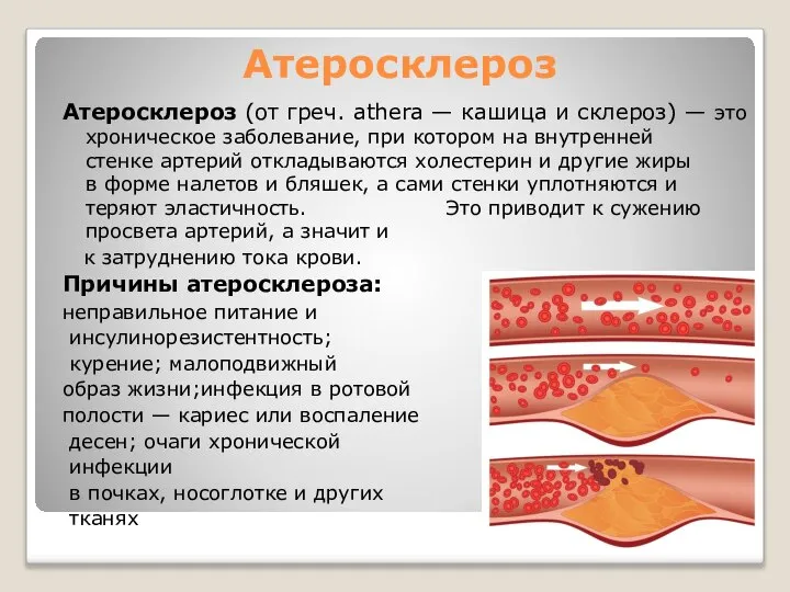 Атеросклероз Атеросклероз (от греч. athera — кaшица и склероз) — это хроническое