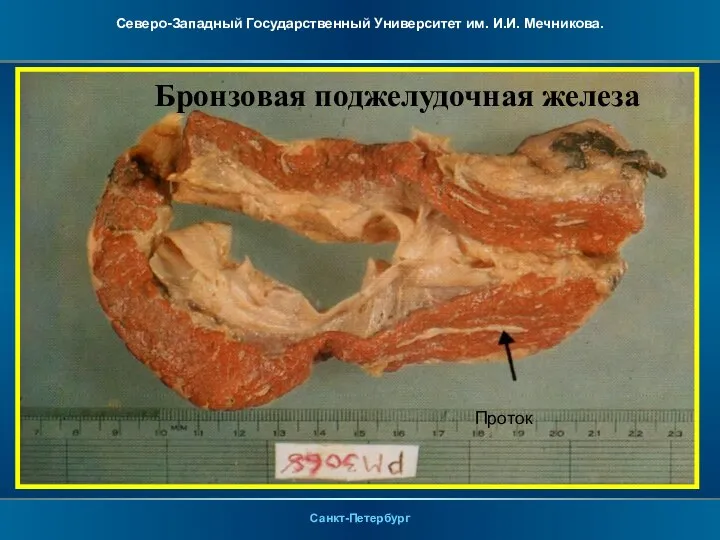 Проток Бронзовая поджелудочная железа