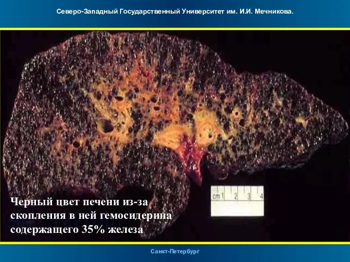 Черный цвет печени из-за скопления в ней гемосидерина содержащего 35% железа