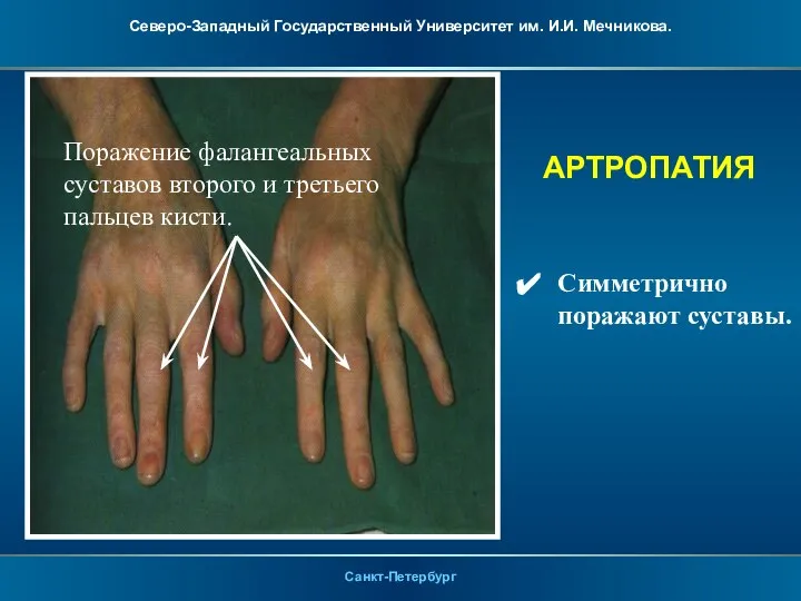 АРТРОПАТИЯ Симметрично поражают суставы. Поражение фалангеальных суставов второго и третьего пальцев кисти.