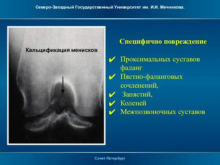 Кальцификация менисков Специфично повреждение Проксимальных суставов фаланг Пястно-фаланговых сочленений, Запястий, Коленей Межпозвоночных суставов