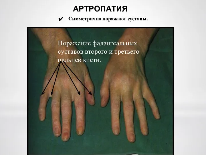 АРТРОПАТИЯ Симметрично поражают суставы. Поражение фалангеальных суставов второго и третьего пальцев кисти.