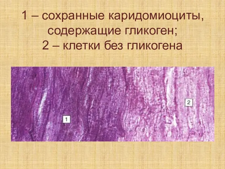 1 – сохранные каридомиоциты, содержащие гликоген; 2 – клетки без гликогена