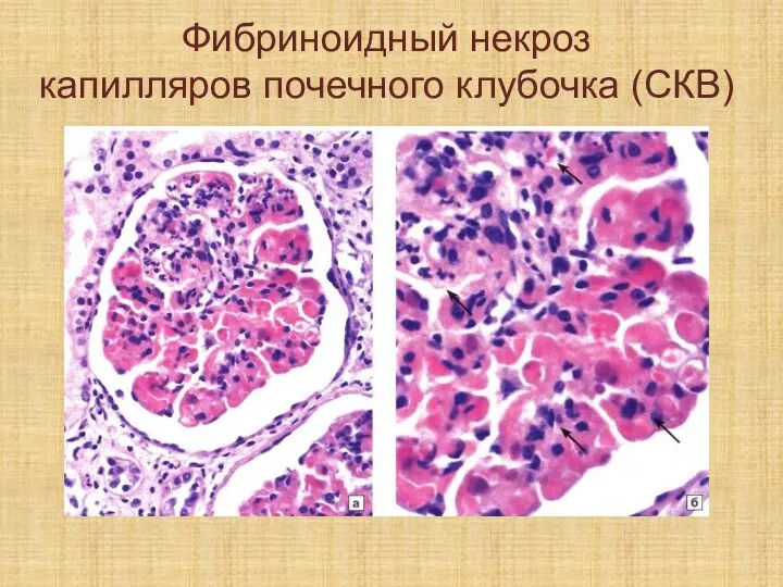 Фибриноидный некроз капилляров почечного клубочка (СКВ)