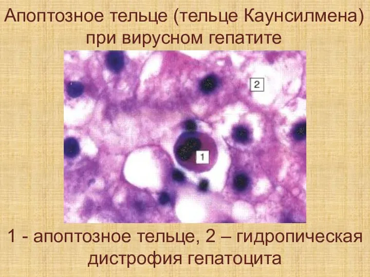Апоптозное тельце (тельце Каунсилмена) при вирусном гепатите 1 - апоптозное тельце, 2 – гидропическая дистрофия гепатоцита