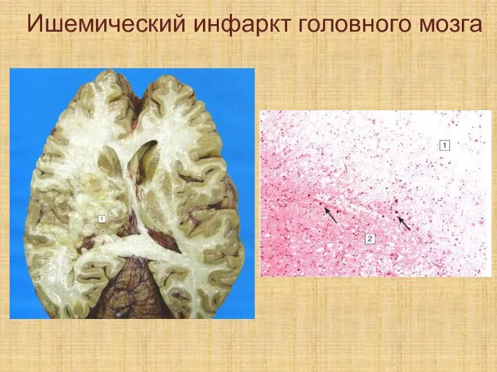 Ишемический инфаркт головного мозга
