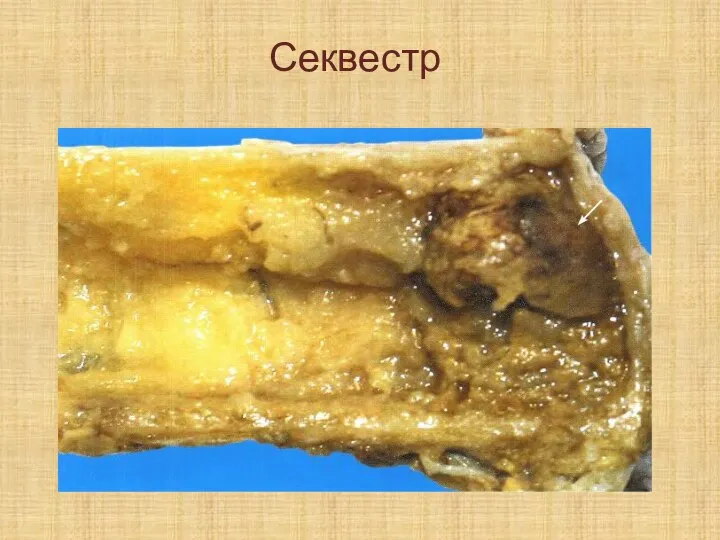 Секвестр