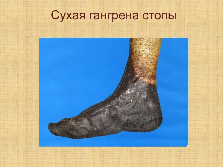 Сухая гангрена стопы