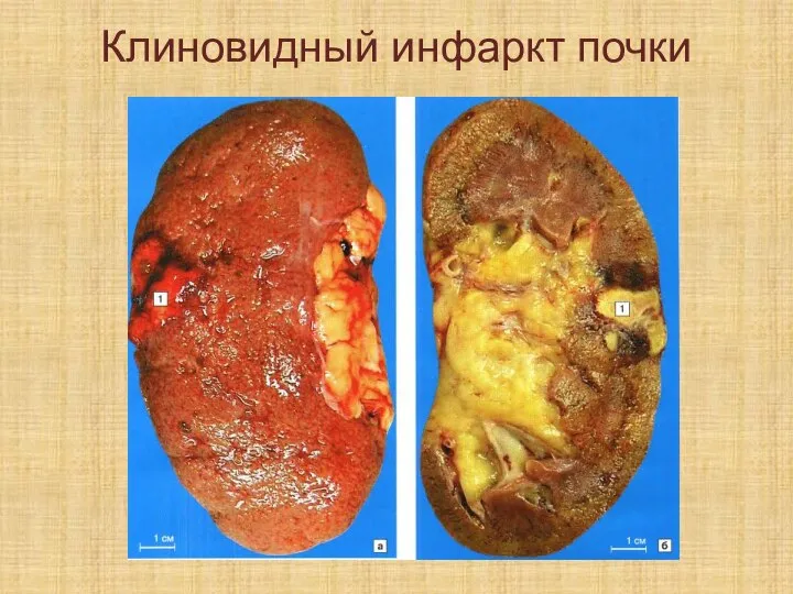 Клиновидный инфаркт почки