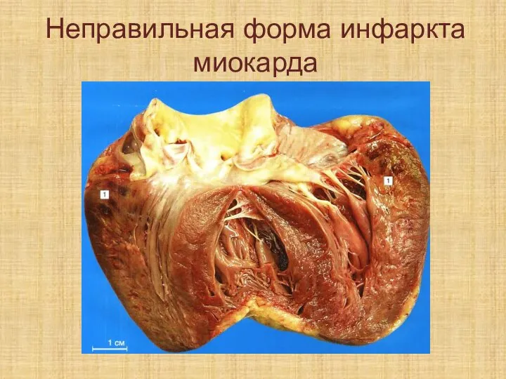Неправильная форма инфаркта миокарда