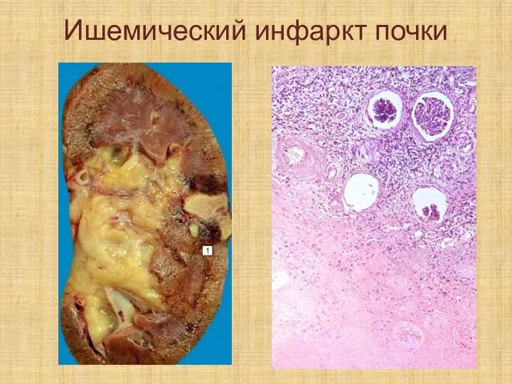 Ишемический инфаркт почки