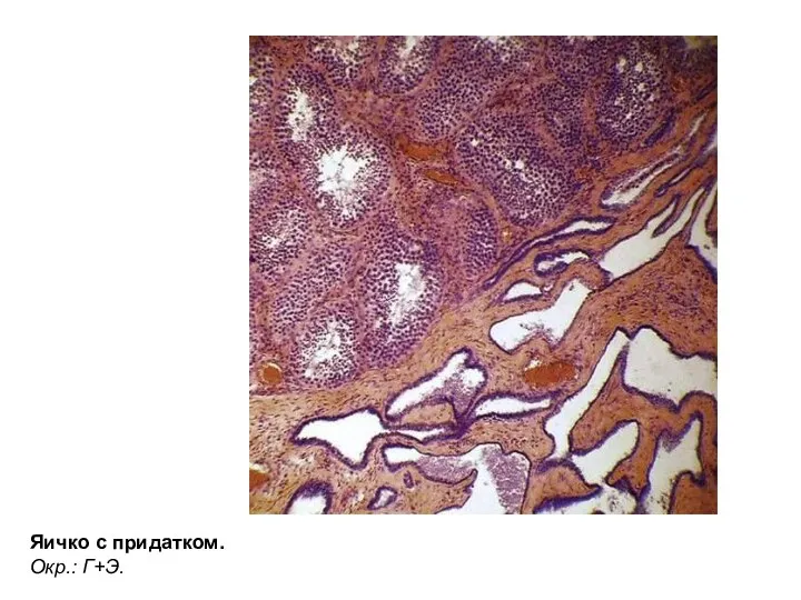 Яичко с придатком. Окр.: Г+Э.