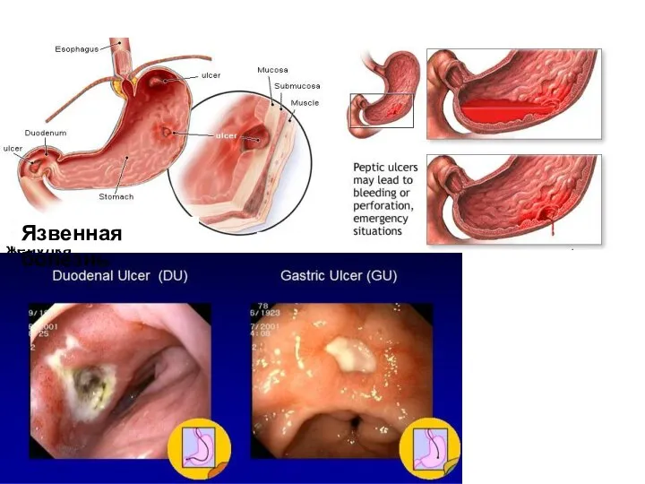 Язвенная болезнь желудка Язвенная болезнь